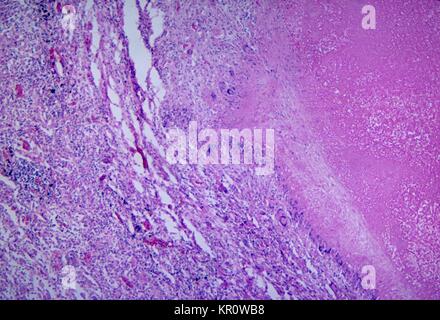 Cette microphotographie montre les changements histopathologiques associées à zygomycosis du poumon, 1965. L'infection, due à des membres de la classe Zygomycetes, implique généralement la rhino-faciale-crânien, poumons, tube digestif, et la peau. Cette maladie survient plus souvent chez les sujets immunodéprimés, ou des patients brûlés, ou ceux de la corticothérapie. Image courtoisie CDC/Dr. Martin Hicklin. Banque D'Images