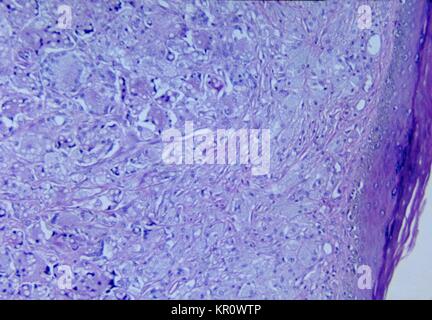 Cette microphotographie montre les changements histopathologiques associées à lobomycosis de la peau, 1965. Cette infection fongique chronique est causée par le champignon Lacazia loboi, anciennement nommée Loboa loboi, et se caractérise par des lésions nodulaires keloidal survenant sur le visage, les oreilles, et des membres. Cette maladie est habituellement trouvé chez les humains et les dauphins. Image courtoisie CDC/Dr. Martin Hicklin. Banque D'Images