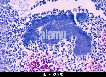 Cette microphotographie montre des changements histopathologiques en raison de l'organisme à gram positif, Actinomyces israelii, 1971. En utilisant une version modifiée de la tache, un Fite-Faraco ?. Le soufre ?. s'affiche des granules dans le milieu de l'image. Ces granules représentent en réalité les colonies d'A. israelii, anaérobies à Gram positif, les bactéries filamenteuses. Image courtoisie CDC/Dr. Lucille Georg. Banque D'Images