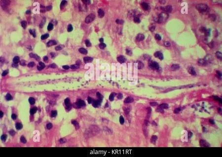 Cette microphotographie révèle un Strongyloides stercoralis parasite intégré dans la muqueuse intestinale, 1972. S. stercoralis est un nématode parasite qui infecte les humains, les primates, et les chiens. Le cycle de vie est complexe, alternant entre libres et parasites, cycles et comprend autoinfection et la multiplication à l'intérieur de l'hôte. Image courtoisie CDC/Dr. Fred Gilbert. Banque D'Images