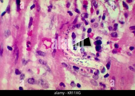 Cette microphotographie révèle un Strongyloides stercoralis parasite intégré dans la paroi intestinale, 1972. S. stercoralis est un nématode parasite qui infecte les humains, les primates, et les chiens. Le cycle de vie est complexe, alternant entre libres et parasites, cycles et comprend autoinfection et la multiplication à l'intérieur de l'hôte. Image courtoisie CDC/Dr. Fred Gilbert. Banque D'Images