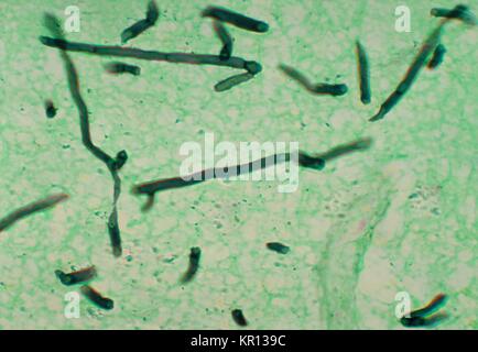 Micrographie d'un cerveau à l'aide d'un pigeon d'argent méthénamine teinté, révélant la présence du champignon Ochroconis gallopavum gallopava Dactylaria, autrefois, 1976. Gallopavum Ochroconis est un champignon, ou apparaissant sombre, ce qui provoque des infections cutanées ou sous-cutanée, et est plus susceptible d'être associé à des infections du SNC qui sont généralement limitées au cerveau. Image courtoisie CDC/Dr. Libero Ajello. Banque D'Images