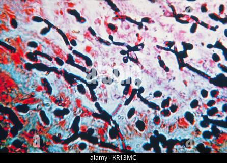 Cette photomicrographie de l'œsophage montre une infection des muqueuses, la candidose, causée par Candida sp, 1963. La candidiase est une maladie infectieuse causée par le champignon opportuniste du genre Candida, qui comprend huit espèces de champignons. La candidiase est généralement limité à la peau et les muqueuses. Image courtoisie CDC/Sherry Brinkman. Banque D'Images