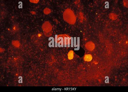 Nous voyons ici Mycobacterium tuberculosis dans un frottis d'expectoration est coloré en utilisant l'acide fluorescent-fast teinté, 1971. M. tuberculosis est un acide-fast bactérie (AFB), et est donc indétectable, lorsque les colorer à l'aide d'une technique de coloration de Gram. Cependant, en utilisant cette méthode, le M. tuberculosis bactéries glow jaune sous la lumière ultraviolette en microscopie électronique. Image courtoisie CDC/Ronald W. Smithwick. Banque D'Images