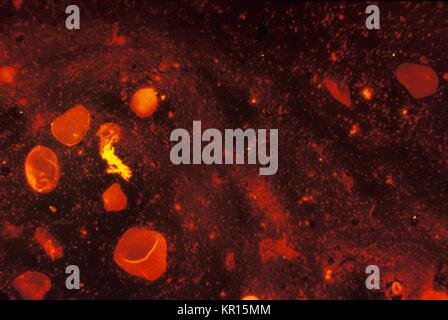 Nous voyons ici Mycobacterium tuberculosis dans un frottis d'expectoration est coloré en utilisant l'acide fluorescent-fast teinté, 1971. M. tuberculosis est un acide-fast bactérie (AFB), et est donc indétectable, lorsque les colorer à l'aide d'une technique de coloration de Gram. Cependant, en utilisant cette méthode, le M. tuberculosis bactéries glow jaune sous la lumière ultraviolette en microscopie électronique. Image courtoisie CDC/Ronald W. Smithwick. Banque D'Images