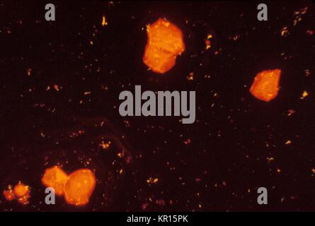 Nous voyons ici Mycobacterium tuberculosis dans un frottis d'expectoration est coloré en utilisant l'acide fluorescent-fast teinté, 1971. M. tuberculosis est un acide-fast bactérie (AFB), et est donc indétectable, lorsque les colorer à l'aide d'une technique de coloration de Gram. Cependant, en utilisant cette méthode, le M. tuberculosis bactéries glow jaune sous la lumière ultraviolette en microscopie électronique. Image courtoisie CDC/Ronald W. Smithwick. Banque D'Images