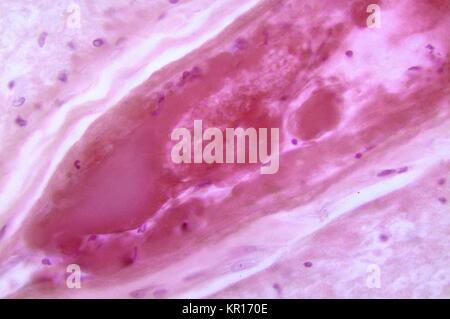 Une photomicrographie de la moelle lombaire présentant un infarctus à cause de Poliovirus Type III impliquant la partie antérieure de l'artère vertébrale et les tissus nerveux, 1964. Quand la mort des neurones spinaux, dégénération Wallerian a lieu entraînant une faiblesse musculaire des muscles innervés par une fois les neurones morts maintenant dénervé (). Le degré de paralysie est directement corrélé au nombre de neurones de la personne décédée. Image courtoisie CDC/Dr. Karp, l'Université Emory. Banque D'Images