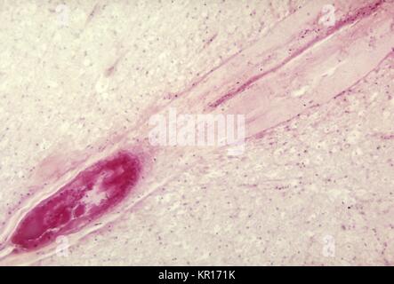 Une photomicrographie de la moelle lombaire présentant un infarctus à cause de Poliovirus Type III entourant l'artère vertébrale antérieure, 1964. Quand la mort des neurones spinaux, dégénération Wallerian a lieu entraînant une faiblesse musculaire des muscles innervés par une fois les neurones morts maintenant dénervé (). Le degré de paralysie est directement corrélé au nombre de neurones de la personne décédée. Image courtoisie CDC/Dr. Karp, l'Université Emory. Banque D'Images