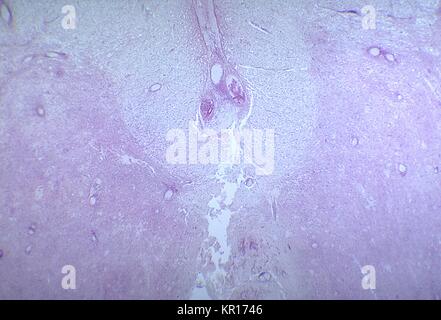 Une photomicrographie de la moelle lombaire présentant une dégénérescence due à un infarctus causé par la polio de type III, 1964. Quand la mort des neurones spinaux, dégénération Wallerian a lieu entraînant une faiblesse musculaire des muscles innervés par une fois les neurones morts maintenant dénervé (). Le degré de paralysie est directement corrélé au nombre de neurones de la personne décédée. Image courtoisie CDC/Dr. Karp, l'Université Emory. Banque D'Images