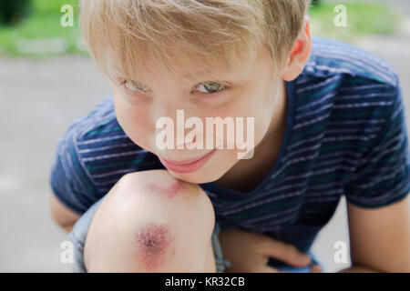 Gros plan du jeune blessé kid's genou après il est tombé sur la chaussée. Funny cute boy pose pour l'appareil photo montrant des blessés a raclé la jambe. Banque D'Images