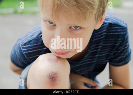 Gros plan du jeune blessé kid's genou après il est tombé sur la chaussée. Visage du garçon blessé et grattées sur jambe journée d'été à l'extérieur. Photo couleur horizontal. Banque D'Images