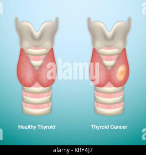 La santé de la glande thyroïde et le cancer de la thyroïde. EPS10 Vector Illustration. Illustration de Vecteur