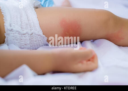 Jambe de dormir petits enfant avec rougeur sur la peau, souffrant d'allergies alimentaires, la jambe de bébé couverts par l'eczéma dermatite allergique de la peau de bébé. L'alimentation. Banque D'Images