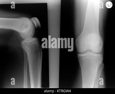 X-ray du genou gauche d'un homme sans résultats visibles. L'image de droite montre le genou de face (ventrale, ap - antérieur-postérieur). Banque D'Images