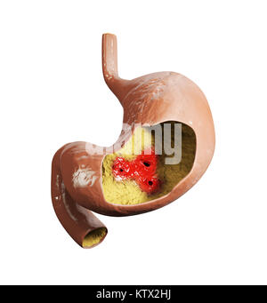 3d illustration d'ulcère de l'estomac anatomie de l'estomac humain. Banque D'Images