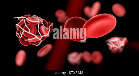 Caillot de sang et de thrombose medical 3d illustration concept. Banque D'Images