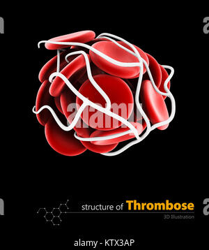 Caillot de sang et de thrombose medical 3d illustration concept isolé. Banque D'Images