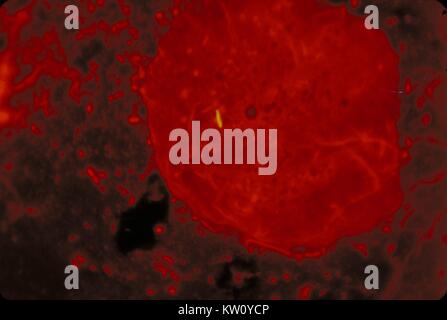 Mycobacterium tuberculosis dans un vitrail à l'aide de frottis est l'auramine fluo avec coloration à l'acridine orange. M. tuberculosis est un acide-fast bactérie (AFB), et est donc indétectable, lorsque les colorer à l'aide d'une technique de coloration de Gram. Cependant, en utilisant cette méthode, le M. tuberculosis bactéries glow jaune sous la lumière ultraviolette en microscopie électronique. Image courtoisie CDC/Ronald W. Smithwick, 1971. Banque D'Images