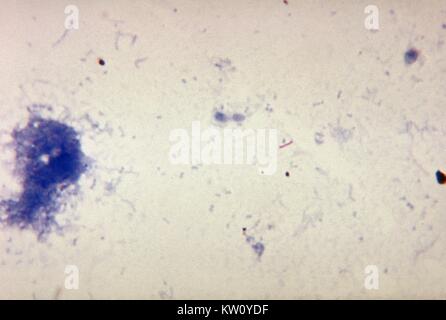 Une photomicrographie de Mycobacterium tuberculosis dans une expectoration, en utilisant l'acide Ziehl-Neelsen-tache rapide technique. L'infection est transmise d'une personne à une autre lorsqu'une personne infectée tousse ou éternue, ce qui, en libérant microdroplets, contenant des bactéries dans l'air d'être inhalée par un destinataire non infectés, qui devient infecté. Image courtoisie CDC/Ronald W. Smithwick, 1971. Banque D'Images