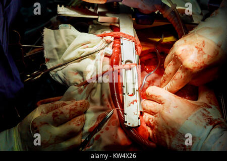 Chirurgien avec son équipe d'effectuer une chirurgie le patient en salle d'opération de l'hôpital. Les médecins au cours de l'intervention en salle d'opération. Banque D'Images