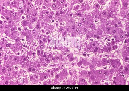 Cette microphotographie montre du tissu hépatique humain infecté par le virus Ebola, 1977. L'agent pathogène d'Ebola est membre de la famille des Filoviridae des virus à ARN. Il est connu pour se propager par contact étroit avec un hôte infecté. Image courtoisie CDC/Dr. Fred Murphy. Banque D'Images