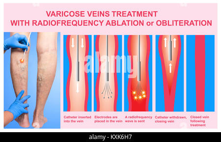 Varices et le traitement par ablation par radiofréquence Banque D'Images