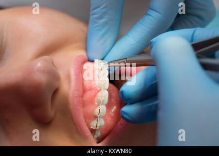 Dentiste contrôle de support à l'accolades sur la patiente. Close-up. De vraies personnes. L'installation d'breackets dentiste Banque D'Images