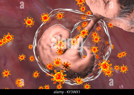 Virus infectant d'embryon humain, illustration conceptuelle. L'embryon est de 4 semaines. De nombreux virus provoquent des malformations foetales ou mort-né. Par exemple, la rubéole, l'herpès et le cytomégalovirus provoquer différentes pathologies fœtales, tandis que l'infection rougeoleuse fœtale mène habituellement à la mortinaissance. Banque D'Images