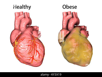 Coeur d'une personne en bonne santé (à gauche) et une personne en surpoids (droit, obésité cœur), illustration de l'ordinateur. Banque D'Images