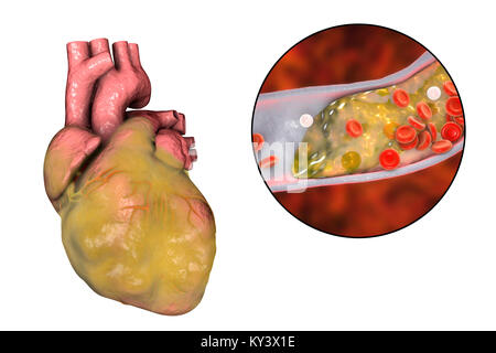 Illustration d'ordinateur d'un cœur gras et une artère coronaire rétrécie par une plaque d'acides gras. Banque D'Images