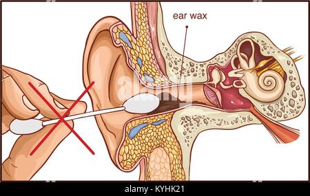 La Section de l'oreille avec le cerumen - schéma coloré Illustration de Vecteur