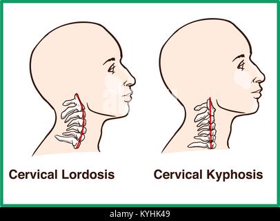 La normale par rapport à l'inversion de la lordose cervicale Illustration de Vecteur