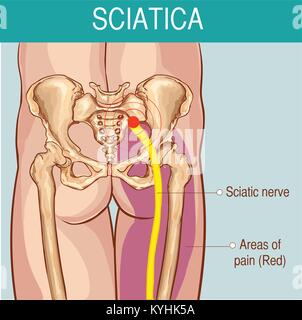 Symptômes de illustration médicale de sciatique Illustration de Vecteur