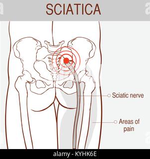 Vector illustration d'un des symptômes de la sciatique Illustration de Vecteur