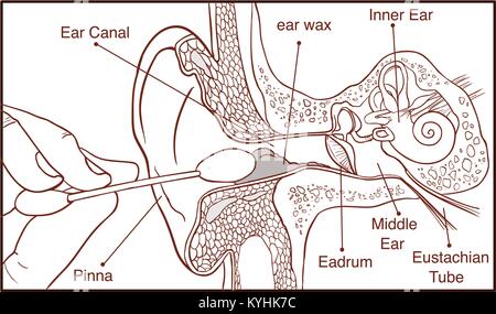 La Section de l'oreille avec le cerumen - schéma coloré Illustration de Vecteur