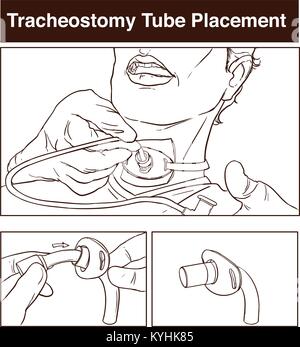 Vector illustration d'un tube de trachéotomie le placement. Illustration de Vecteur