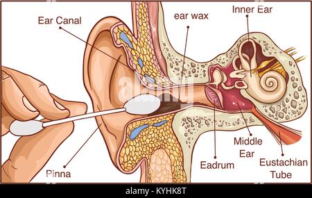 La Section de l'oreille avec le cerumen - schéma coloré Illustration de Vecteur