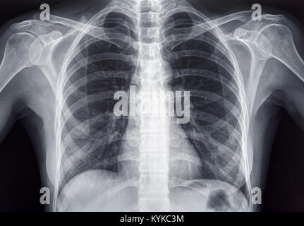 Radiographie pulmonaire d'un adulte femme humain Banque D'Images