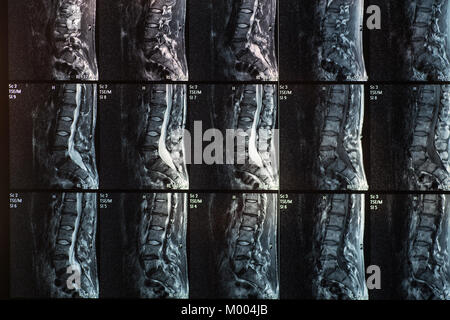 L'image par résonance magnétique de la colonne vertébrale avec hernie discale, la lordose et spondylolisthésis l5-s1 Banque D'Images