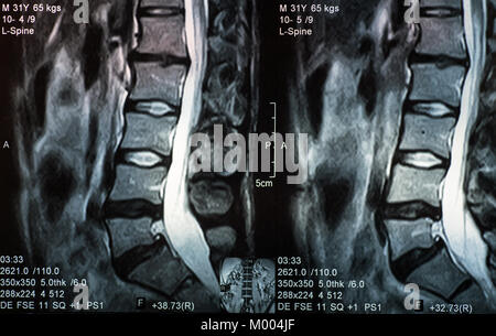 L'image par résonance magnétique de la colonne vertébrale avec hernie discale, la lordose et spondylolisthésis l5-s1 Banque D'Images