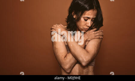 Jeune femme touchées par le vitiligo en studio. Femelle avec mauvais problème tan debout sur fond brun. Banque D'Images