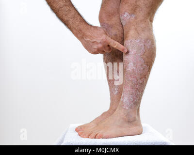 Personne souffrant de psoriasis chronique indique avec le doigt la partie enflammée des jambes, sur un fond blanc. Banque D'Images