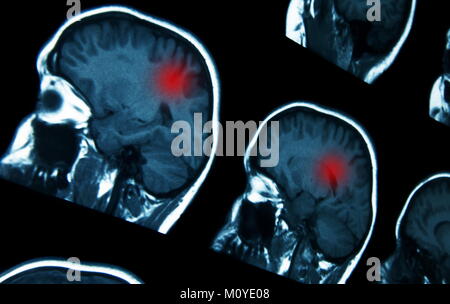 Scan IRM de cerveau avec des problèmes Banque D'Images