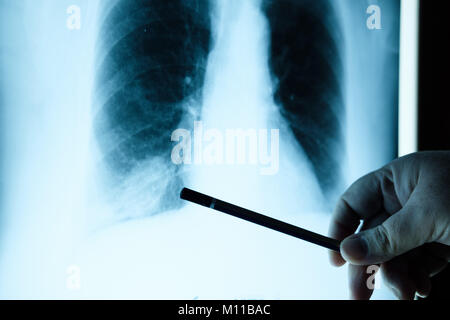 Médecin contrôle radiographie du film. L'examen d'une radiographie pulmonaire Médecin Banque D'Images