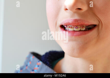 Close up of a Boy's smile with braces Banque D'Images