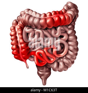 La maladie de Crohn ou la maladie de crohns concept médical comme des intestins à l'inflammation causant des symptômes comme une obstruction 3D illustration. Banque D'Images