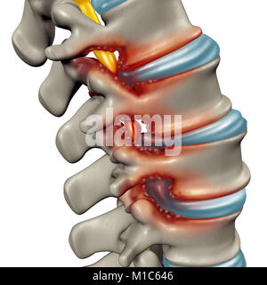 La sténose spinale comme une maladie dégénérative dans les vertèbres de la colonne vertébrale nerfs compressés à l'origine comme un concept médical 3D illustration. Banque D'Images