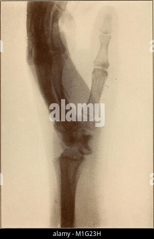 Ce traité de 1912 fournit un examen approfondi des fractures et des luxations, détaillant leurs causes, symptômes, méthodes de traitement et stratégies de rétablissement. Il sert de guide pratique pour les professionnels de la santé dans la prise en charge des lésions osseuses. Banque D'Images