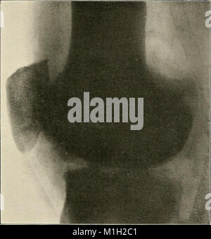 Un atlas radiographique des changements pathologiques des os et des articulations (1911) (14757914732) Banque D'Images