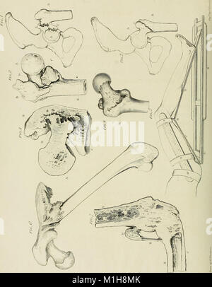 Un traité de luxations et fractures sur des articulations (1824) (14775981762) Banque D'Images